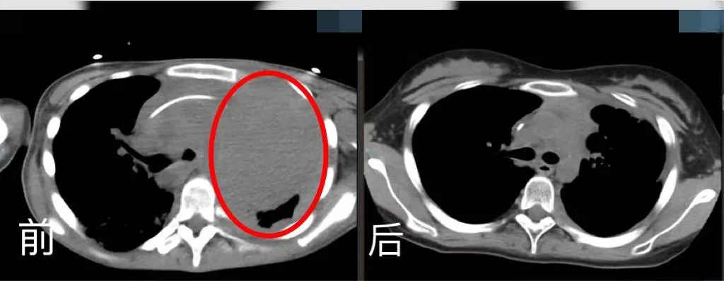 胸腔CT前后對比。四川省腫瘤醫院供圖