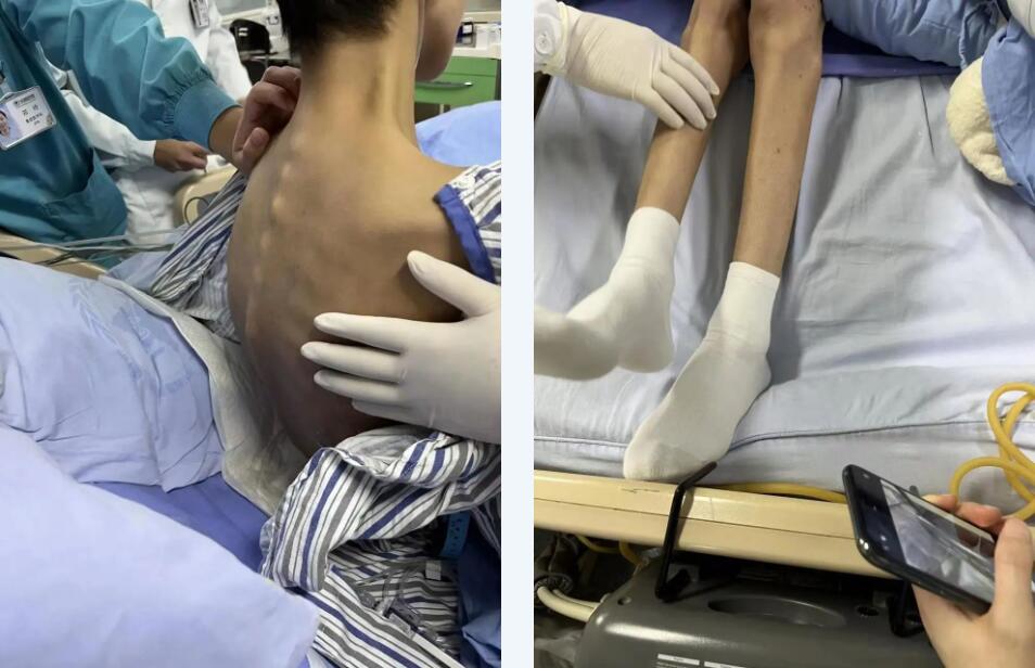 剛入院時的小玉。四川省腫瘤醫院供圖