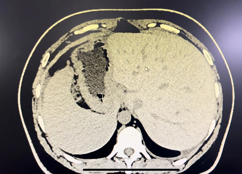 患者內臟反向生長。四川省人民醫院供圖