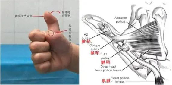 病理情況圖解。四川省骨科醫院供圖