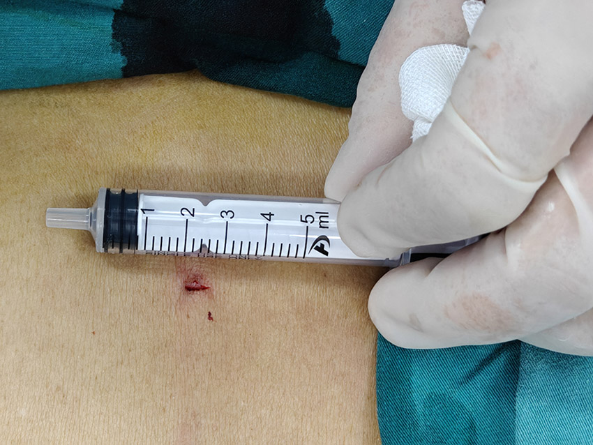 手術切口。綿陽市骨科醫院供圖